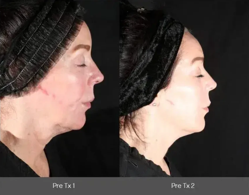 Xerf before and after — Jawline & neck · side profile