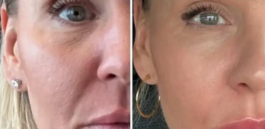 Xerf before and after — Under-eye & cheek